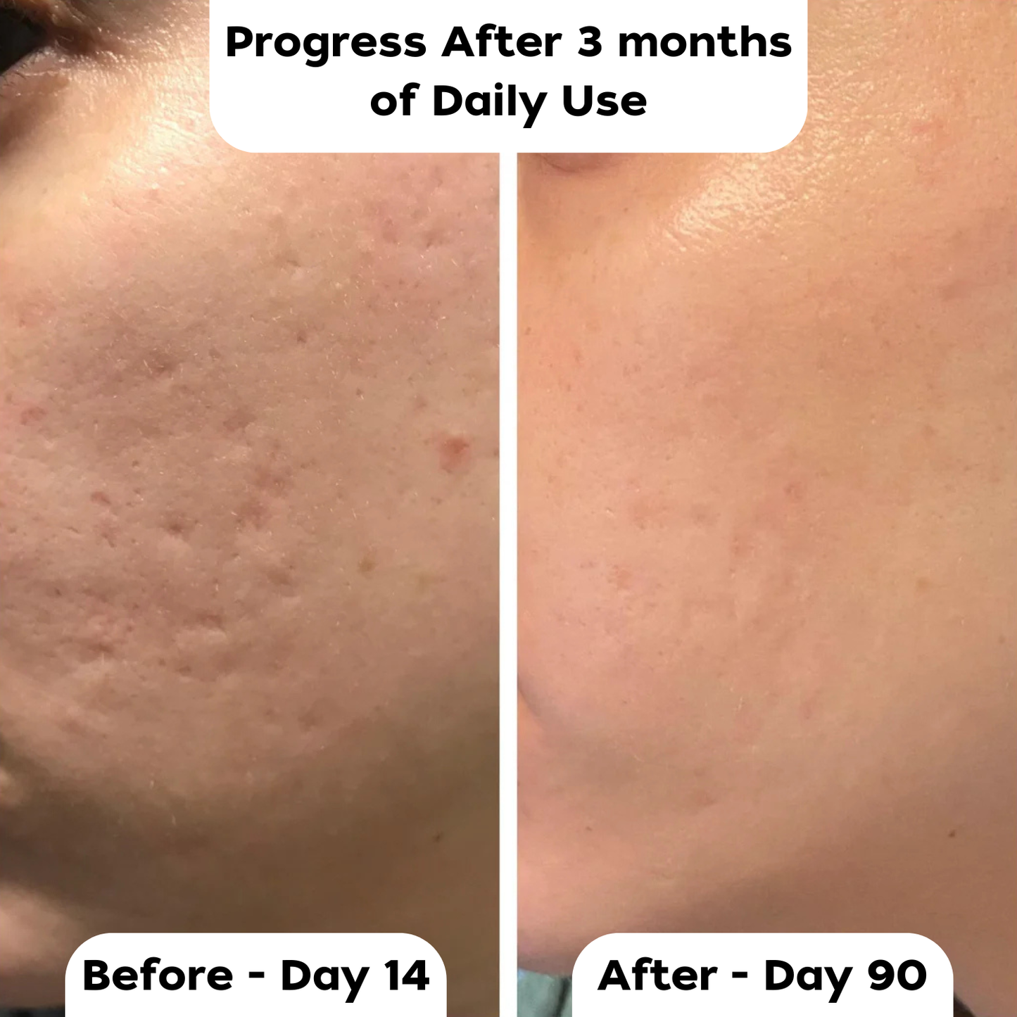 BlissBotanic's Silicone Scar Stick